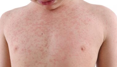 'Strong likelihood' measles spreading in the community