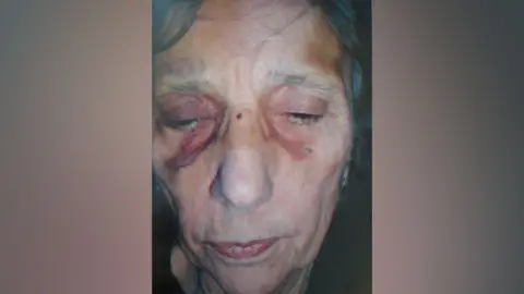 Contributed A close up of Iris Scott's face which has visible purple and yellow bruising on her temples and around her eye sockets.