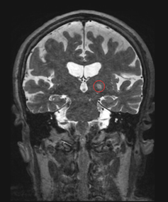 Frontal brain MRI
