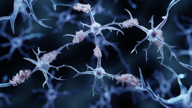 ADAMTS2 Gene Implicated in Alzheimer’s Across Populations