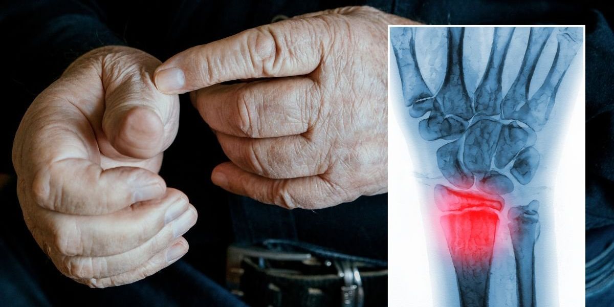 Osteoporosis alert issued over popular medication as doctor warns 'they're not good for bones'
