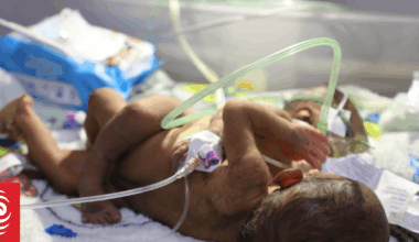 'We're running out of time': PNG parents make desperate global plea to save conjoined twins