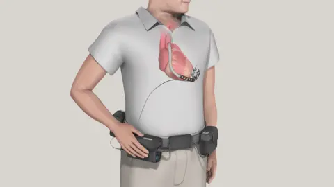 Medtronic An illustration of a man in a white T-shirt wearing a black belt holding four small black devices with wires protruding; higher up, we see a scan of his heart, from which a small pump with a tube emerges. A wire links the device and one of the black devices on his belt.
