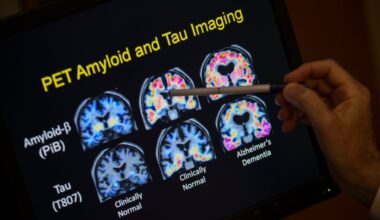 Days after a simple blood test, a person with dementia can learn whether they have Alzheimer’s disease. Experts say these tests are problematic. They have concerns about accuracy, privacy, and access to follow-up care.