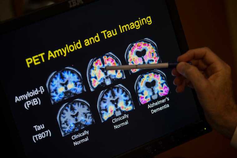 Days after a simple blood test, a person with dementia can learn whether they have Alzheimer’s disease. Experts say these tests are problematic. They have concerns about accuracy, privacy, and access to follow-up care.