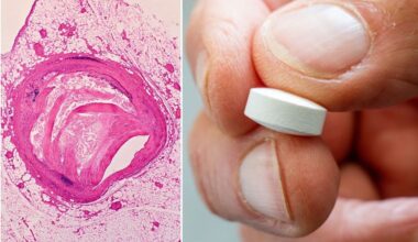 Drug that slashes bad cholesterol levels by nearly 60% offers hope to statin-resistant patients