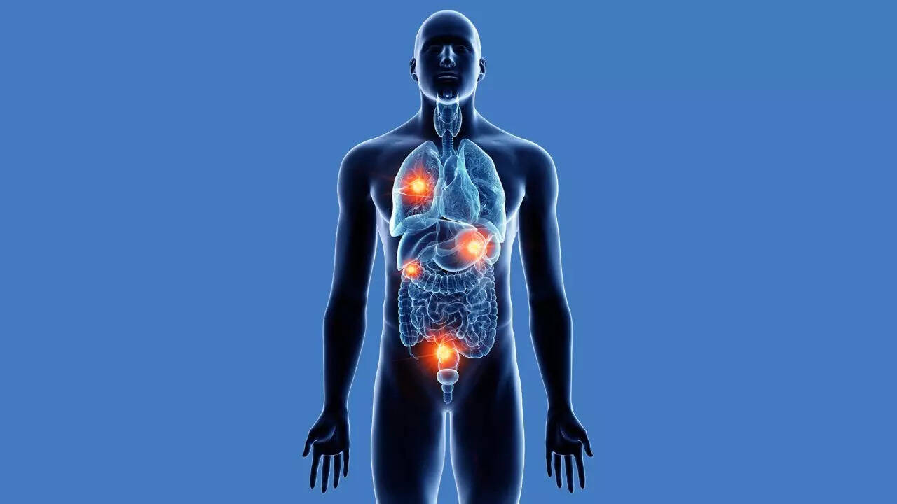 Oligometastatic cancer (2)