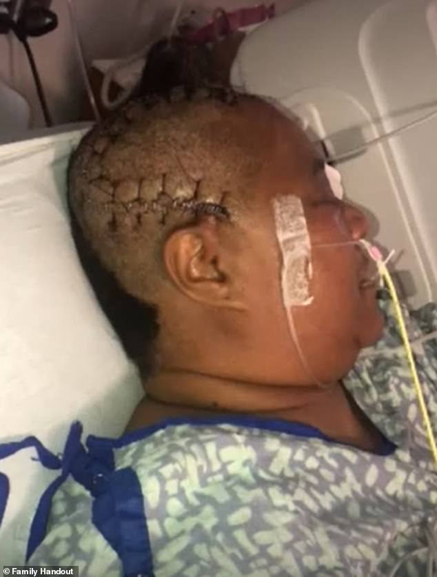 Surgeons replaced the gap with a prosthetic plate, but Burton¿s family says she is now unable to talk or eat without a feeding tube, requires around-the-clock care and remains bed-bound