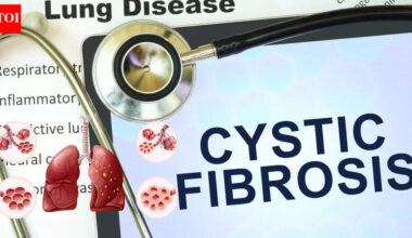 Cystic Fibrosis: Causes, symptoms, diagnosis and modern treatment approaches |