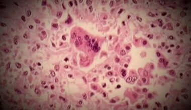 Measles outbreak grows to 8 cases in Quebec