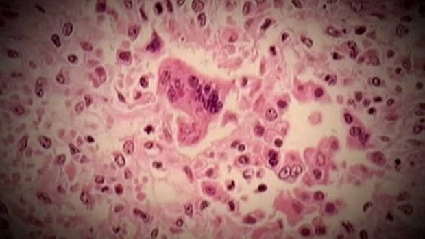 Measles outbreak grows to 8 cases in Quebec