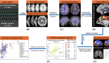 Transcriptomic decoding of regional cortical vulnerability to drug-resistant epilepsy using 7T MRI