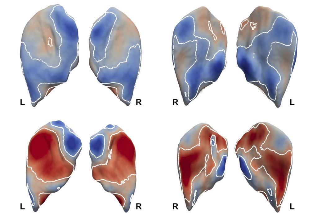 Gluteus maximus shape analysis in men (above) and women (below). Blue represents inward deformation or atrophy, while red represents outward deformation or fatty hypertrophy.
