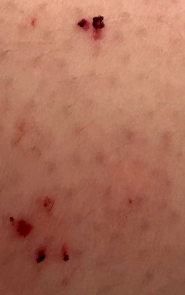 Reptile Relocation Sydney Facebook The suspected snake bites