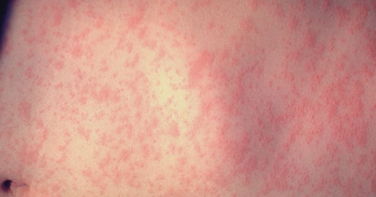 Mass. health officials warn of possible measles exposures – Boston 25 News