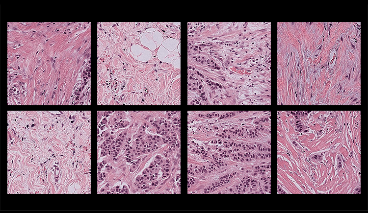 Researchers Discover Bias in AI Models That Analyze Pathology Samples