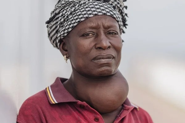 a woman with a large goitre on her neck looks at the camera
