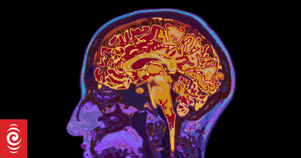 US firm trialling Huntington's disease treatment says it shows promising early results