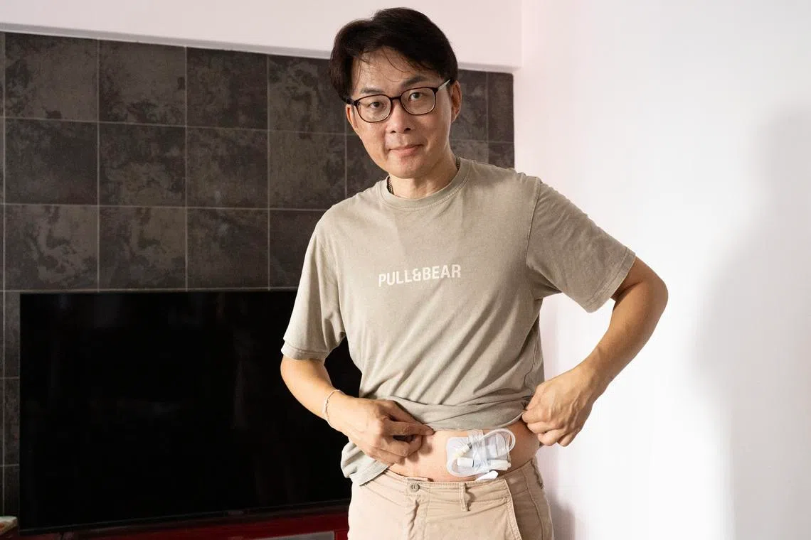 This picture shows the access point and catheter required for peritoneal dialysis, with the catheter inserted into Mr Nelson Chew's belly. PHOTO: THE STRAITS TIMES