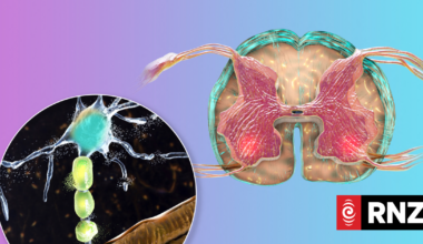 New Zealanders missing out on motor neurone disease treatment, study shows