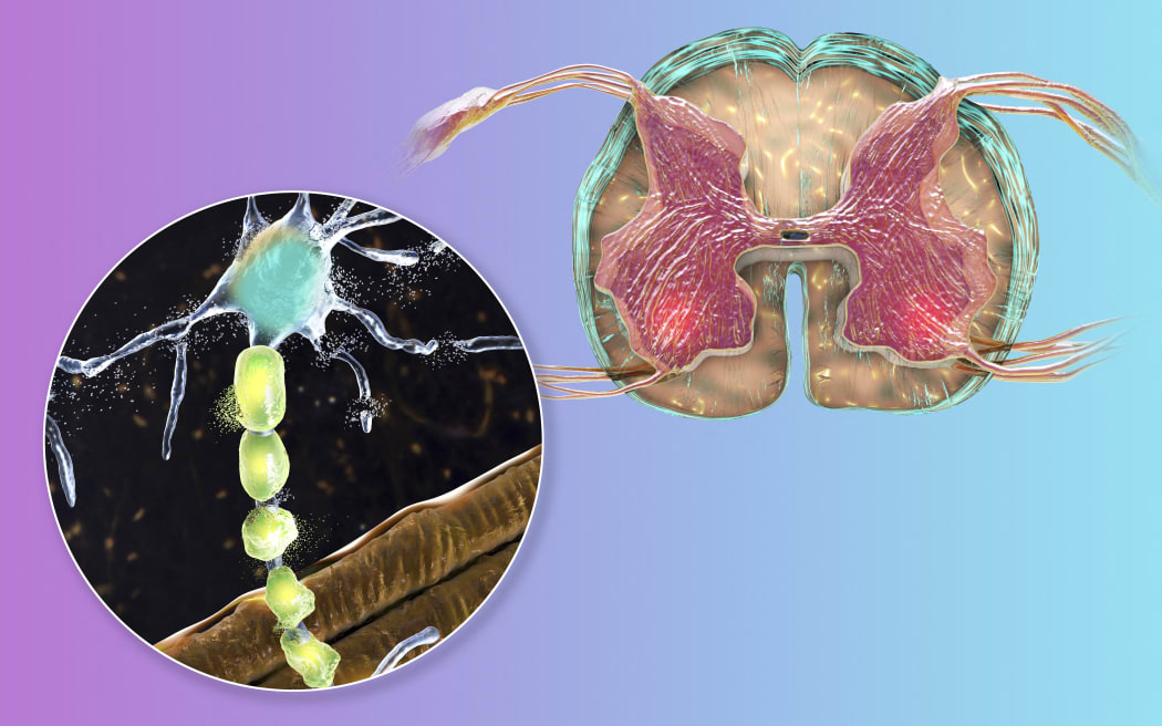 Illustration of motor neuron diseases, showing degeneration of motor neurons in anterior horns of spinal cord.