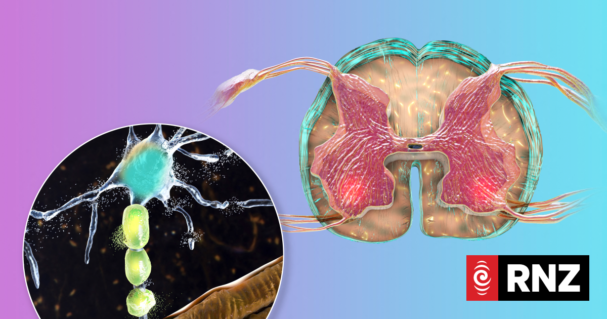 New Zealanders missing out on motor neurone disease treatment, study shows