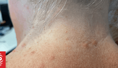 Microscopic jellyfish bring unwelcome sting for Bream Bay swimmers