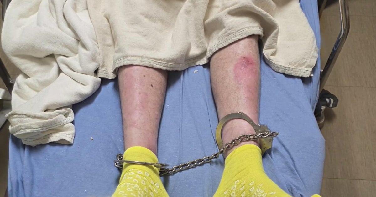 Libyan man in Minnesota for medical treatment for rare skin condition is detained by ICE agents