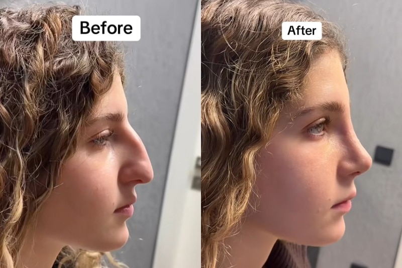 Two photos of a girl's side profile, before and after a nose job.