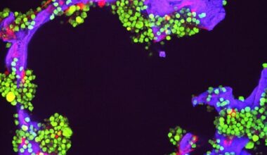 Why are men more likely to develop multiple myeloma than women?