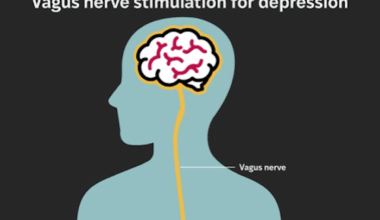 Implant provides lasting relief for treatment-resistant depression – WashU Medicine