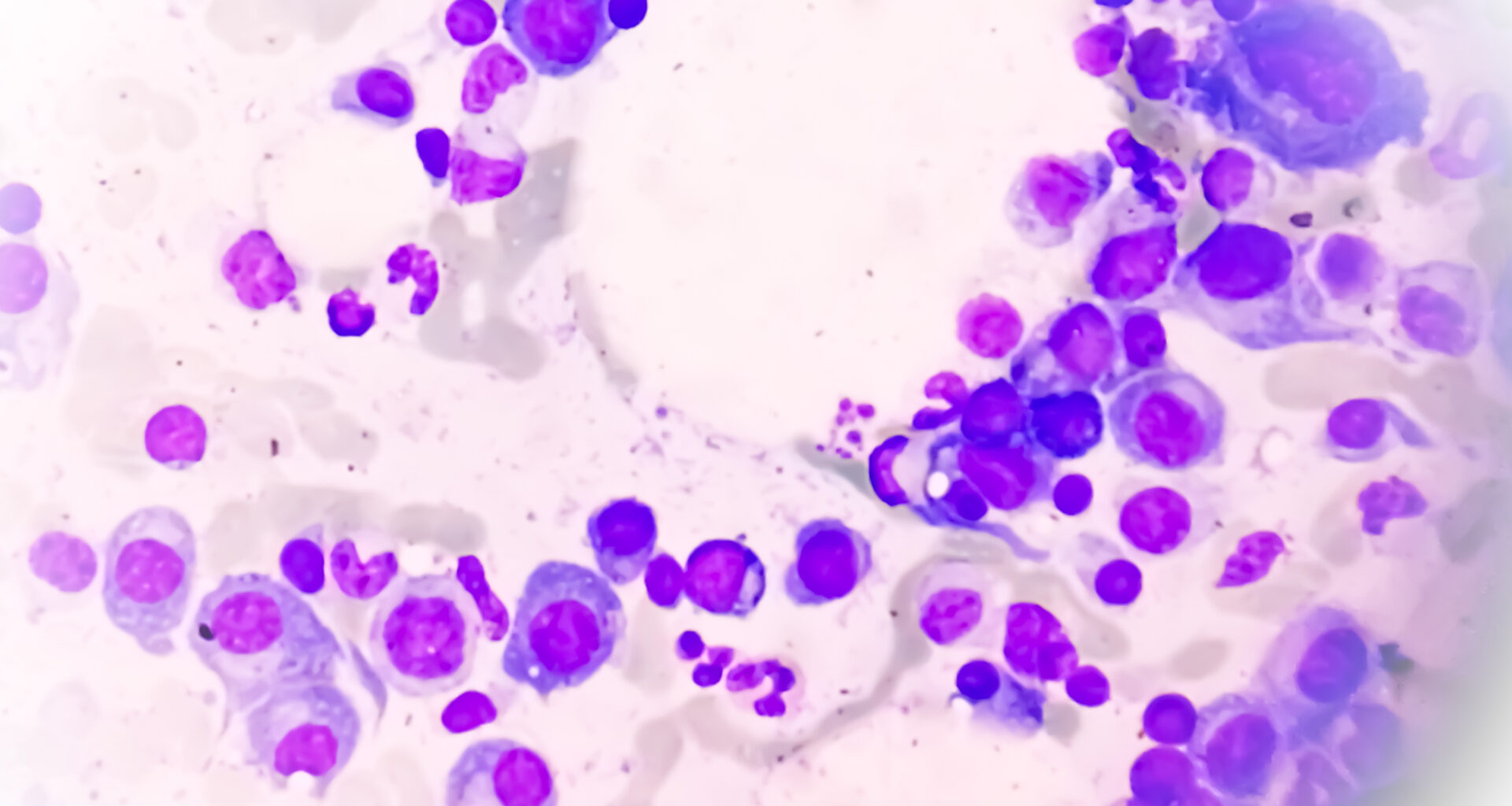 Largest Immune Cell Atlas of Multiple Myeloma Predicts Recurrence Risk