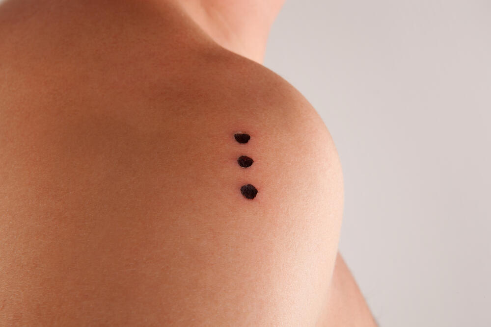 The burn marks left on the skin after the ritual (Photo: Shutterstock) הצריבות שנשארות על העור לאחר הטקס