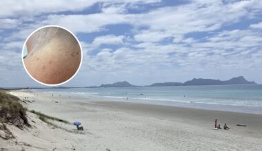 Bream Bay jellyfish stings: Swimmers hit by painful rash at Ruakākā