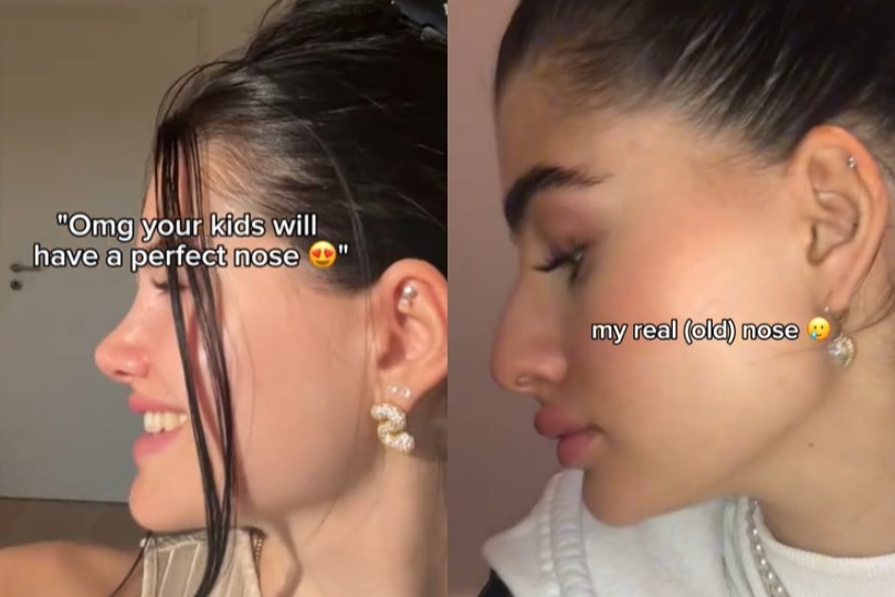 A composite image of a woman after and before a nose job.