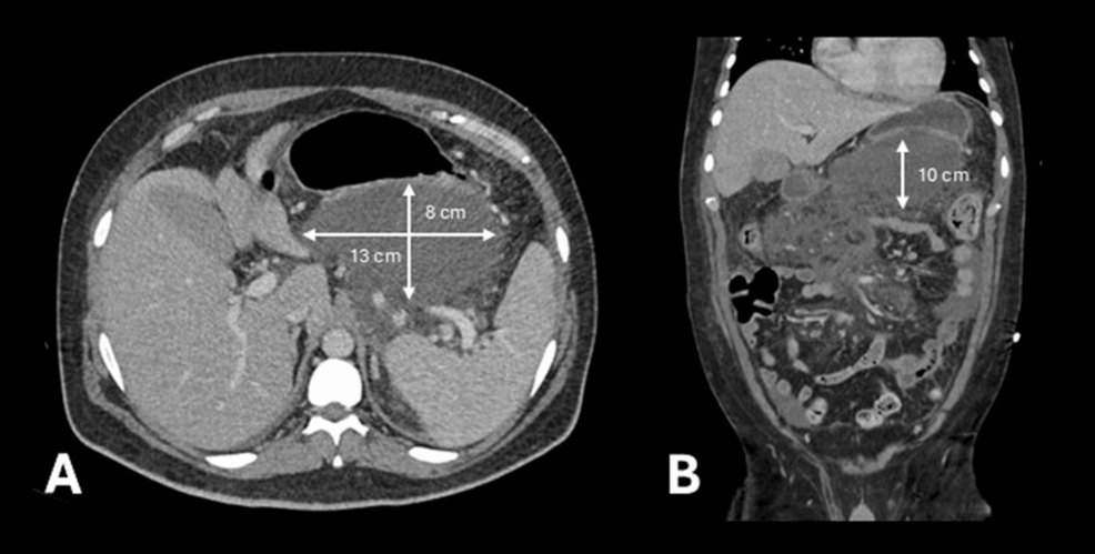 Complex Management of an Infected Pancreatic Collection With Walled-Off Necrosis in Acute Pancreatitis: A Case Report