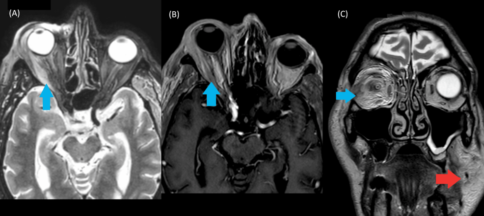 Expanding the Clinical Spectrum of VEXAS (Vacuoles, E1 Enzyme, X-linked, Autoinflammatory, Somatic) Syndrome: The First Report of Histologically Confirmed Neutrophilic Colitis With Rare Muscular and Pancreatic Involvement - Cureus