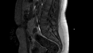 Two Frontlines, One Diagnosis: Family Medicine-Neurology Collaboration Enables Early Recognition and Treatment of Acute Inflammatory Demyelinating Polyneuropathy in a Diabetic Patient