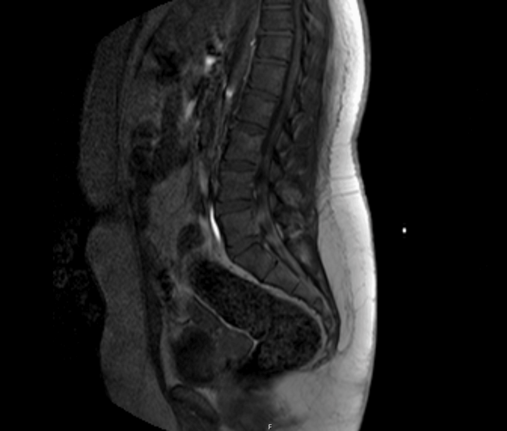 Two Frontlines, One Diagnosis: Family Medicine-Neurology Collaboration Enables Early Recognition and Treatment of Acute Inflammatory Demyelinating Polyneuropathy in a Diabetic Patient