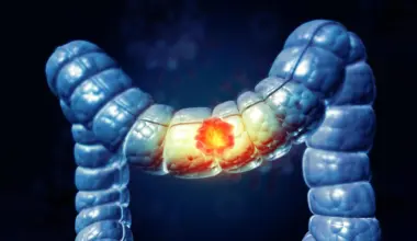 A stiffening colon may be fueling cancer in younger adults