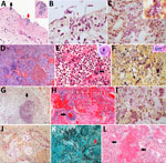Pulmonary microscopic findings in patients with fatal yellow fever, São Paulo, Brazil, 2017–2019. A) Tracheal necrosis associated with bacilli (black arrow) and yeasts (inset and red arrow). Hematoxylin and eosin (HE) stain; scale bar = 50 µm. B) Candida albicans pseudohyphae and hyphae invading necrotic tracheal mucosa. Gram stain in immersion oil; scale bar = 10 µm. C) Bronchopneumonia associated with gram-negative bacilli. Gram stain; scale bar = 20 µm. D) Hemorrhagic pneumonia with microabscess composed of macrophages, neutrophils and colonies of coccus. HE stain; scale bar = 100 µm. E) Suppurative pneumonia showing hemophagocytosis (left inset) and a megakaryocyte in a septal vessel (arrow), with emperipolesis. HE stain; scale bar = 20 µm. Inset: megakaryocyte labeled by VIII factor antigen detected by immunohistochemistry. Peroxidase stain. F) Polymicrobial aspirative pneumonia with gram-positive cocci and gram-positive and gram-negative bacilli with different morphologies; the inset show a colony of bacilli in a septal vessel corresponding to agonal bacteremia. Gram stain; scale bar = 20 µm. Inset: HE stain. G) Actynomyces granule (arrow) with degenerated squamous cells in the center in an area of aspirative pneumonia. HE stain; scale bar = 100 µm. H) Pseudomonas hemorrhagic pneumonia, with numerous bacilli surrounding a septal vessel (arrow). HE stain; scale bar = 50 µm. I) Mycoplasma salivarium pneumonia, showing tiny gram-negative bacilli (inset) in the cytoplasm of intrabronchial macrophages. Gram stain; scale bar = 20 µm. J) Bronchoaspiration of vegetal alimentary material, associated with gram-negative bacilli, in the alveolar space. Gram stain; scale bar = 20 µm. K) Pulmonary angioinvasive aspergillosis, with typical hyphae invading pulmonary vessel (arrow), with associated necrosis and mild neutrophilic reaction. Grocott-Gomori methenamine silver stain; scale bar = 20 µm. L) Exudative diffuse alveolar damage, with congestion, alveolar edema, and hyaline membranes (arrow). HE stain; scale bar = 100 µm. Insets: original magnification ×400.