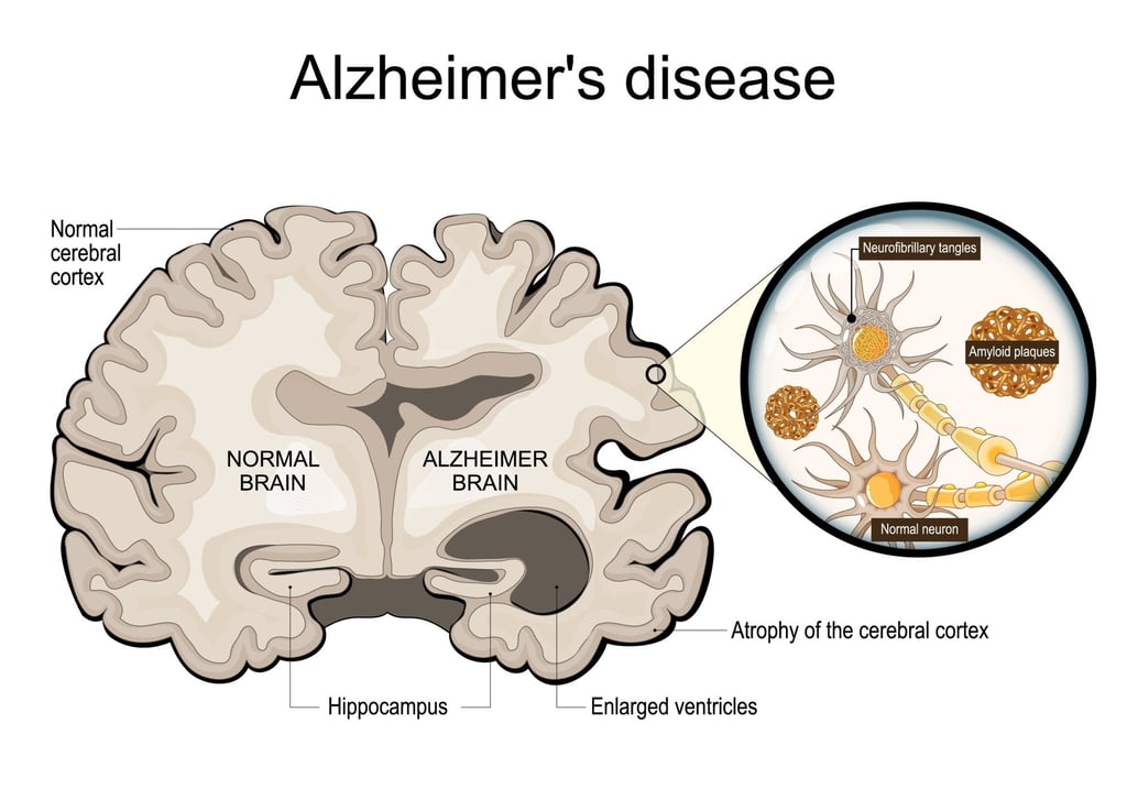 An illustration of a cross-section of a normal brain (left) and one of a brain damaged by Alzheimer’s disease. Photo: Shutterstock