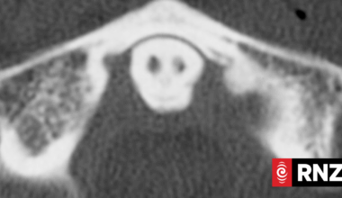 Spooky 'grim reaper' image shows up on medical scan of car crash victim