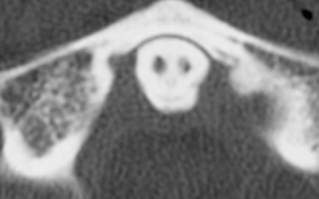 A spooky image described a "grim reaper" has shown up in a medical scan of someone who'd just be in a car accident.