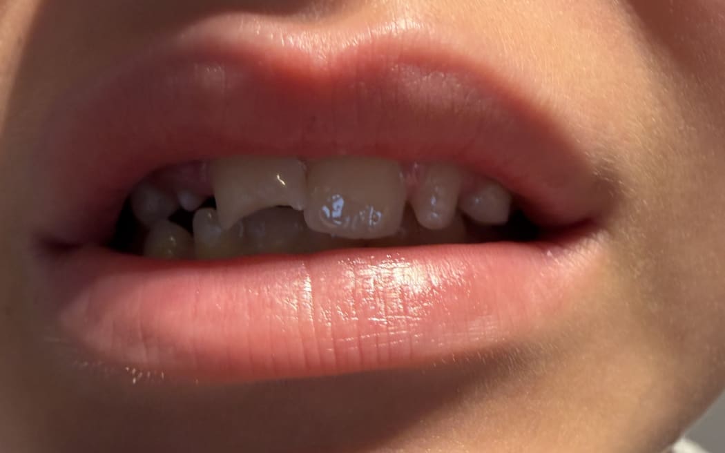 Tanya Rusher's son was left with a chipped tooth after the accident at the Mt Albert Aquatic Centre.