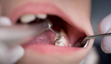 High blood sugar raises risk of tooth decay, study says