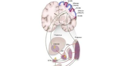 Brain network dysfunction central to Parkinson's disease identified