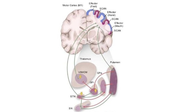 Brain network dysfunction central to Parkinson's disease identified