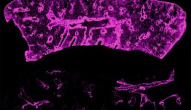 Surprising culprit leads to chronic rejection of transplanted lungs, hearts