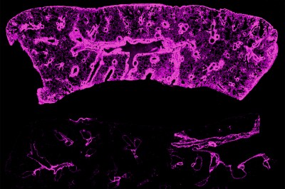 Surprising culprit leads to chronic rejection of transplanted lungs, hearts